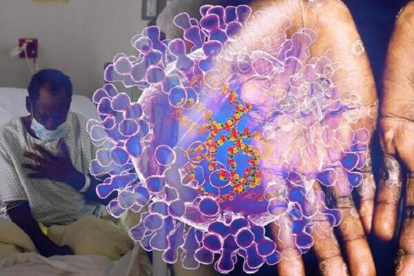 افراد HIV در معرض ابتلا به شدیدترین نوع آبله میمونی افراد HIV در معرض ابتلا به شدیدترین نوع آبله میمونی