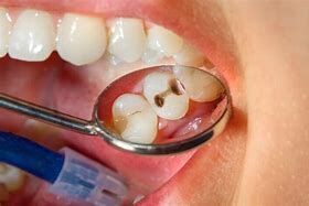 مهمترین عامل جلوگیری کننده از پوسیدگی دندان