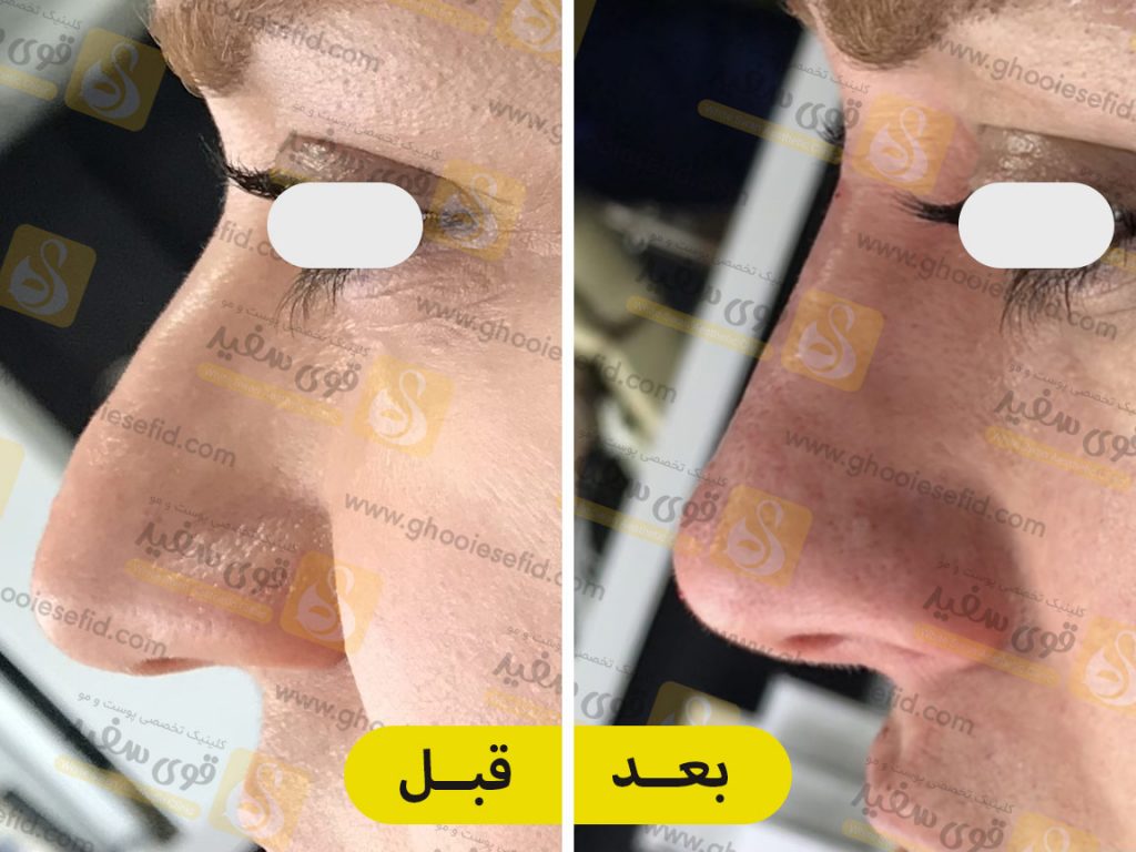 فرم دهی بینی تنها در 10 دقیقه!