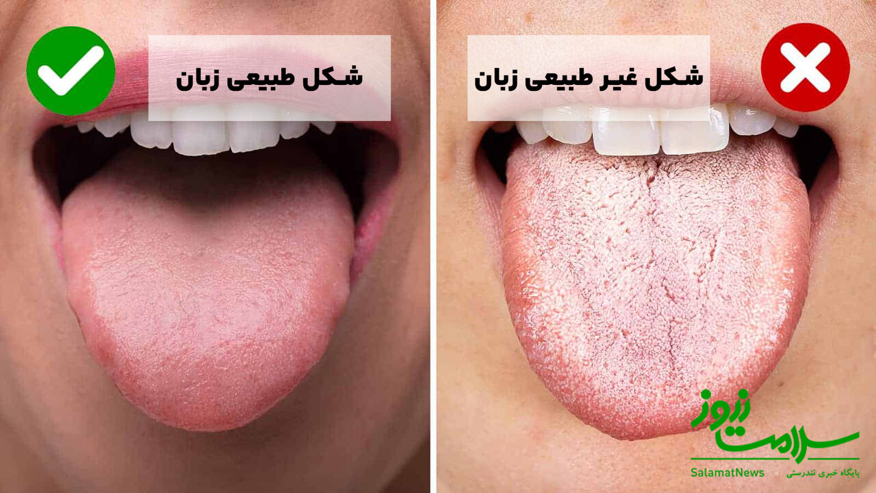 زبان سفید شده