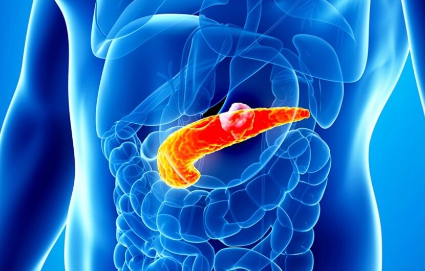 علائم شایع سنگ کیسه صفرا علائم شایع سنگ کیسه صفرا