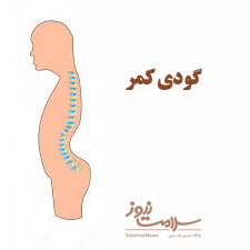 نشانه ها،درمان و حرکات اصلاحی برای گودی کمر