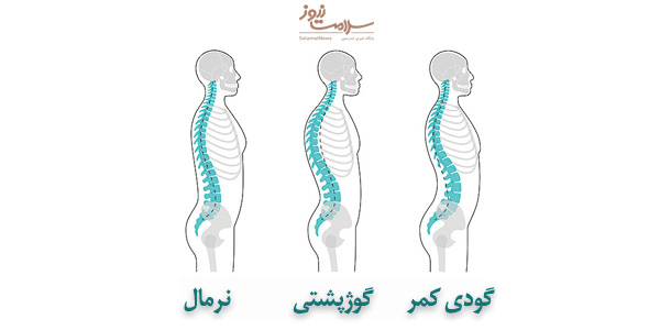 نشانه ها،درمان و حرکات اصلاحی برای گودی کمر