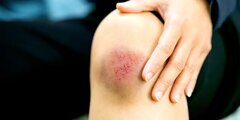 علت ایجاد کبودی‌های ناگهانی بر روی پوست چیست؟