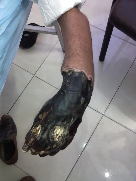 عکسهای دردناکی از بیماران سوخته