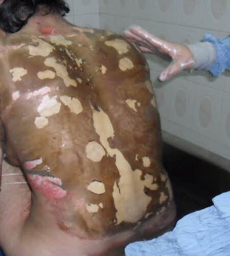 عکسهای دردناکی از بیماران سوخته