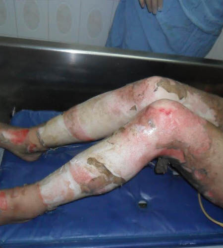 عکسهای دردناکی از بیماران سوخته