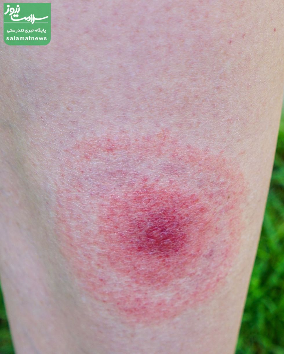 تصاویرِ متداولترین گزیدگی ها