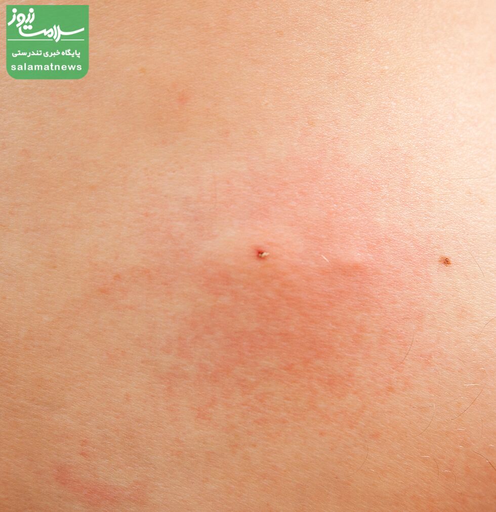 تصاویرِ متداولترین گزیدگی ها