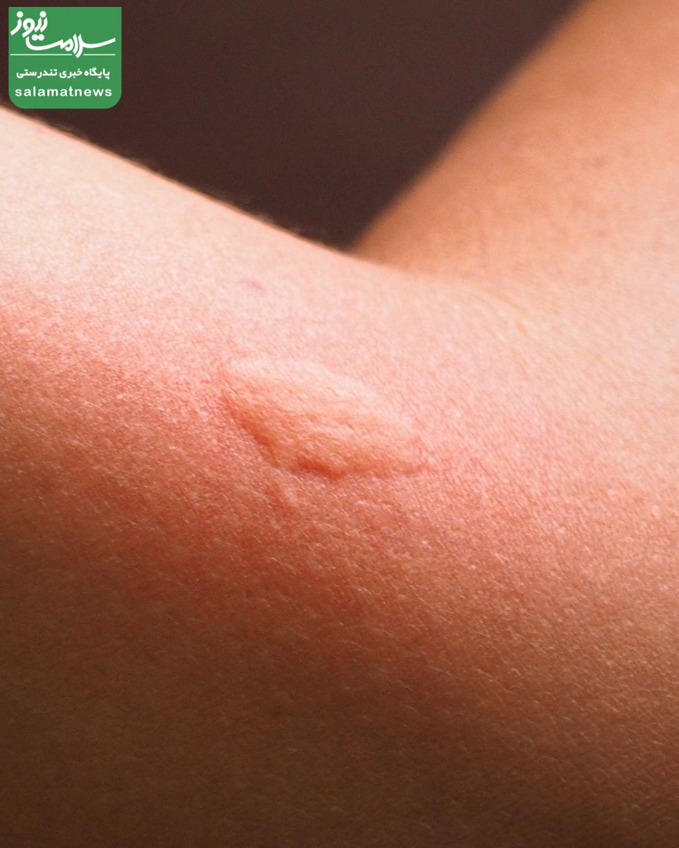 تصاویرِ متداولترین گزیدگی ها