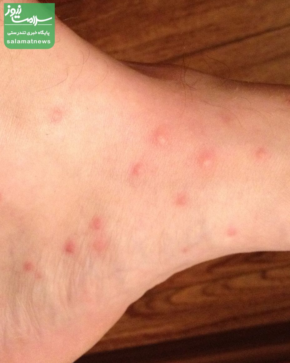 تصاویرِ متداولترین گزیدگی ها