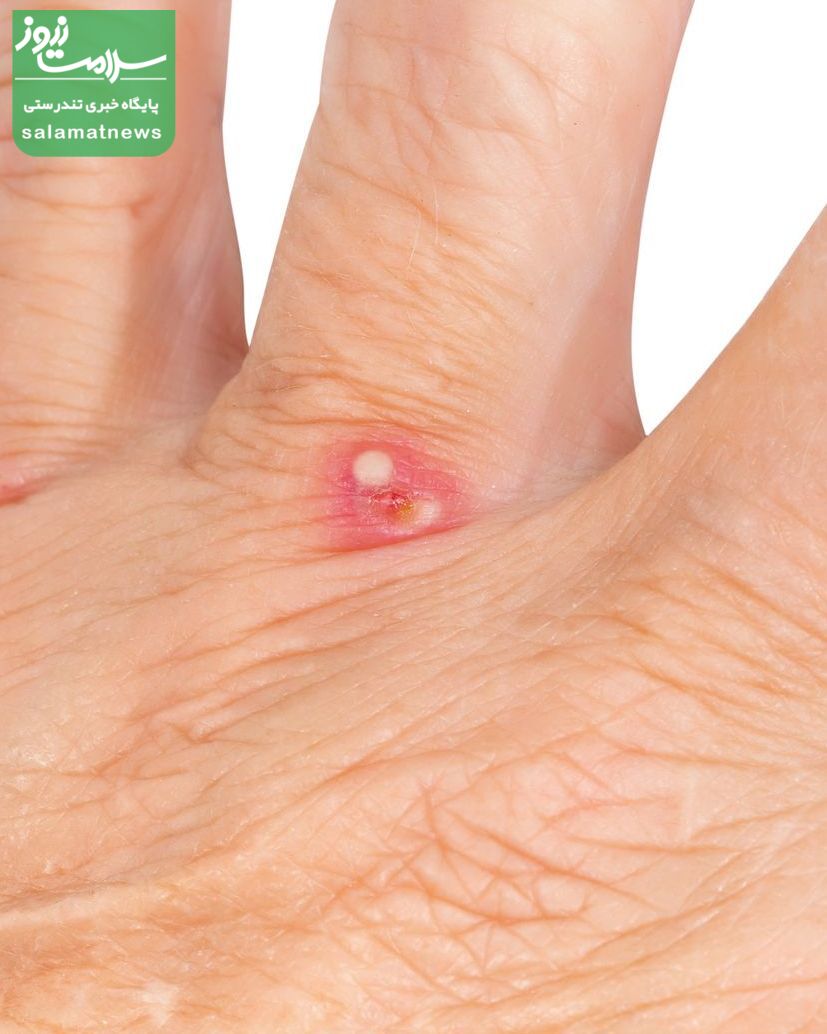 تصاویرِ متداولترین گزیدگی ها