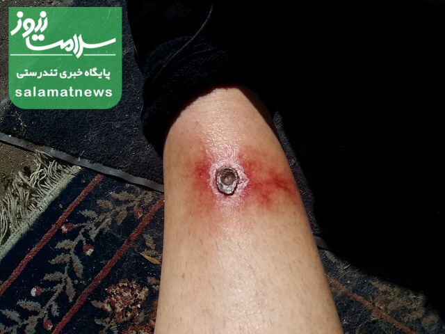 تصاویرِ متداولترین گزیدگی ها