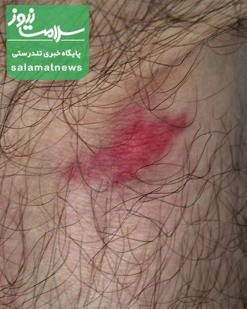 تصاویرِ متداولترین گزیدگی ها