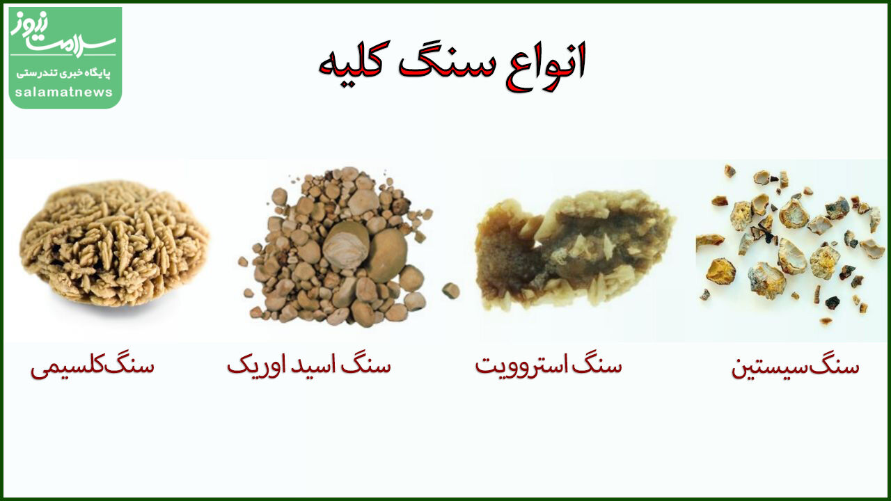 درمان سنگ کلیه را جدی بگیرید