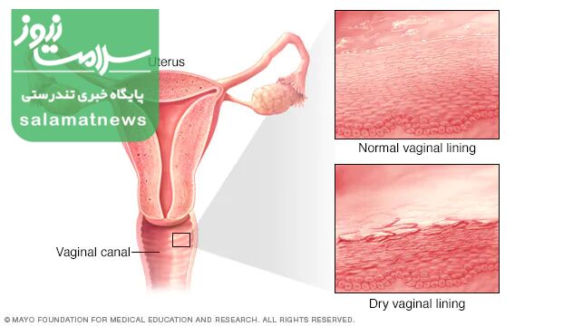 دلایل، راههای تشخیص و درمانِ خشکی واژن در زنان