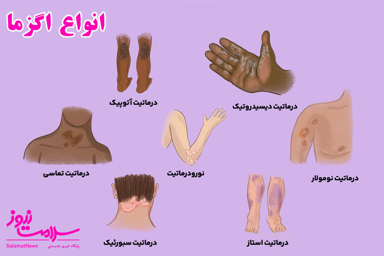انواع اگزما