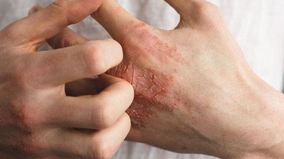  انواع «حساسیت‌های پوستی» و نشانه‌های آن