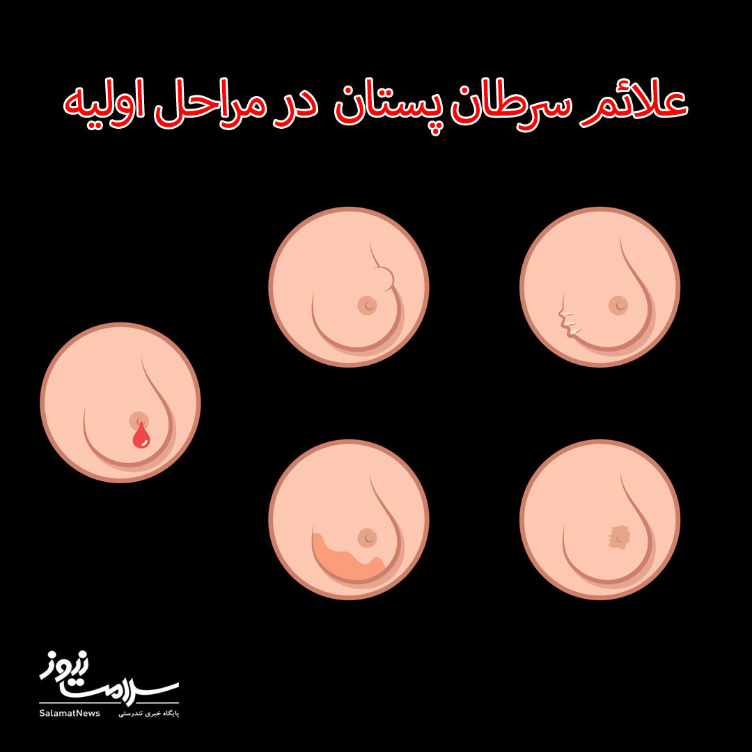 علائم سرطان پستان و راههای تشخیص و درمان آن را بشناسید