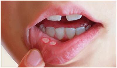 علت بروز آفت دهانی در کودکان