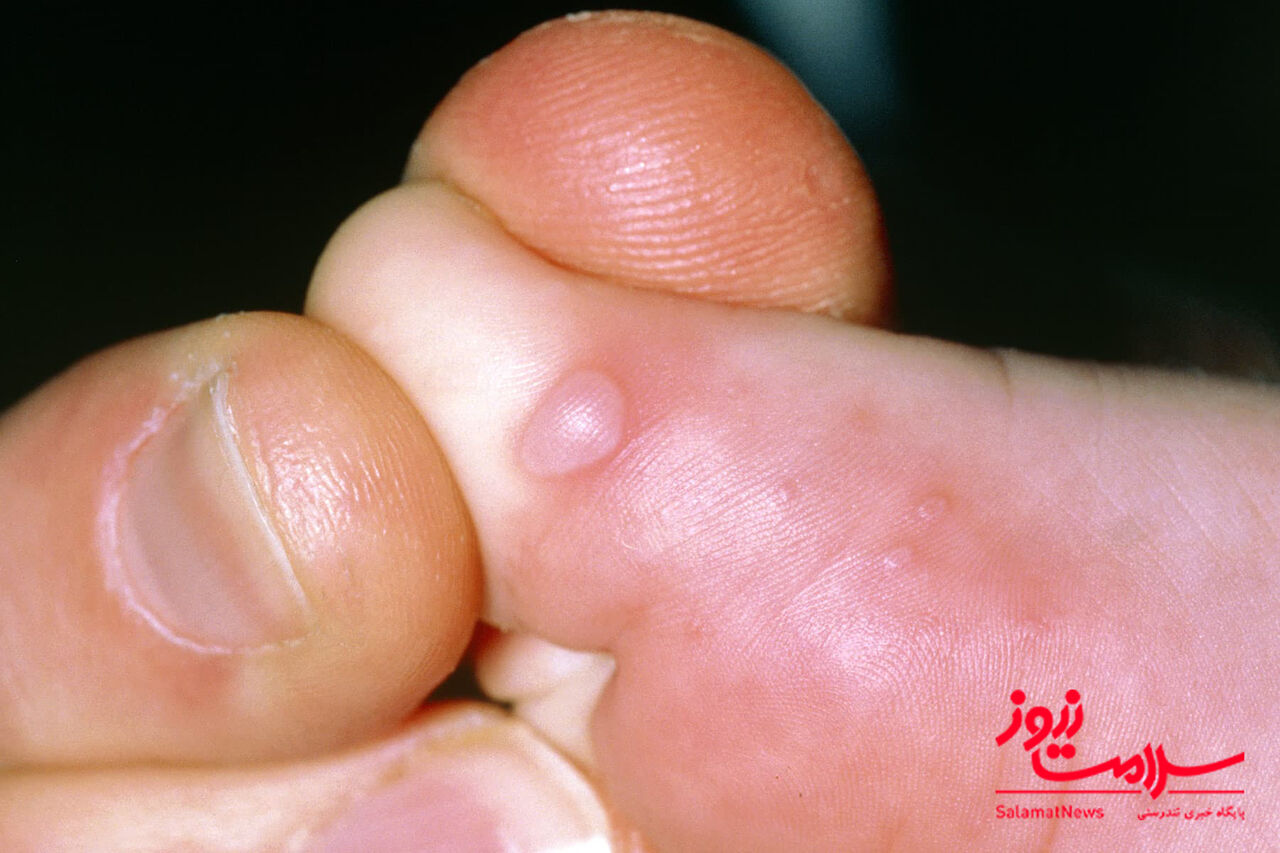 دست پا دهان