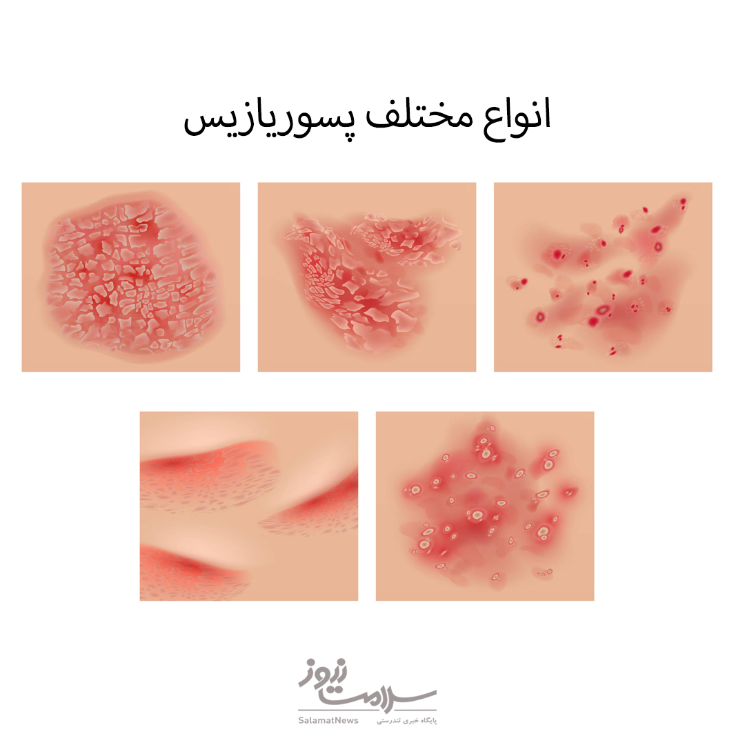 علت، انواع، تشخیص و درمان پسوریازیس