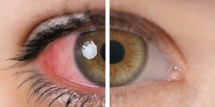 قرمزی نشانه ا ی از التهاب لایه میانی چشم