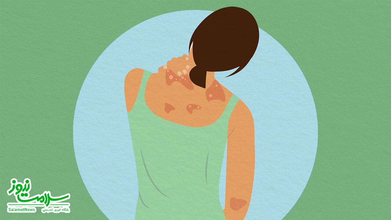 علت، انواع، تشخیص و درمان پسوریازیس علت، انواع، تشخیص و درمان پسوریازیس