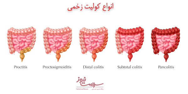 روشهای پیشگیری و درمان کولیت زخمی‌