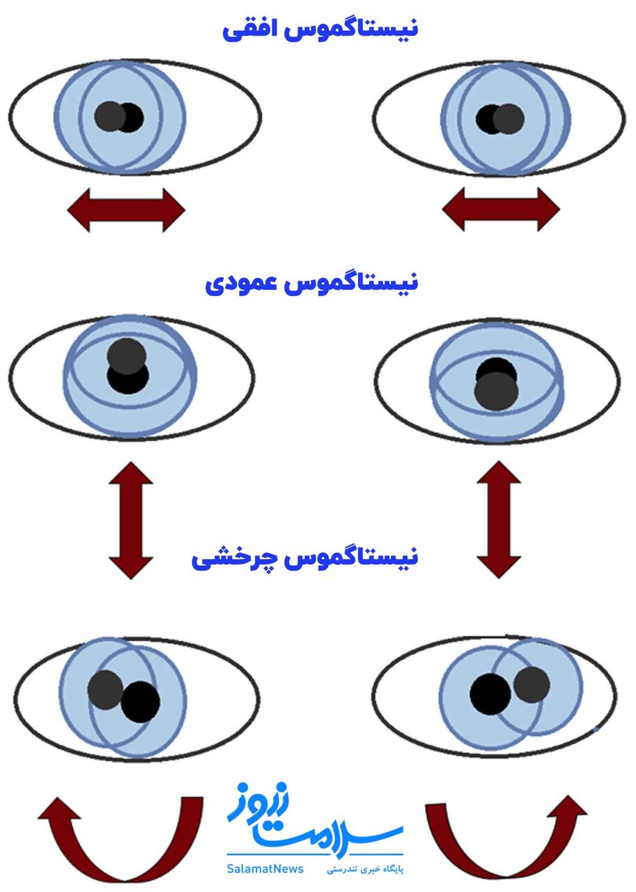 نیستاگموس