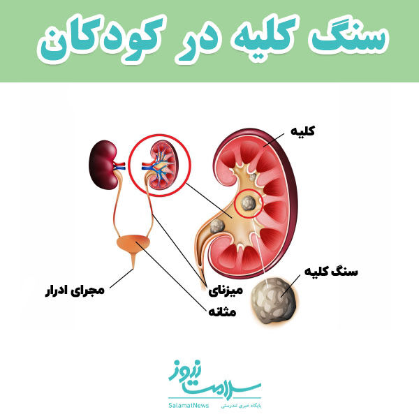 سنگ کلیه در کودکان
