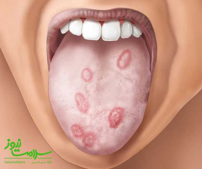 انواع سیفلیس ،نحوه انتقال و روش درمان