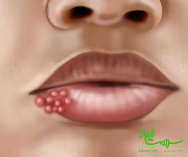 انواع سیفلیس ،نحوه انتقال و روش درمان