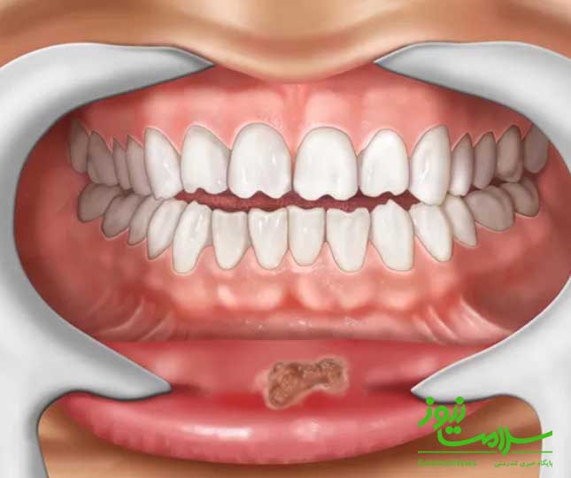 انواع سیفلیس ،نحوه انتقال و روش درمان