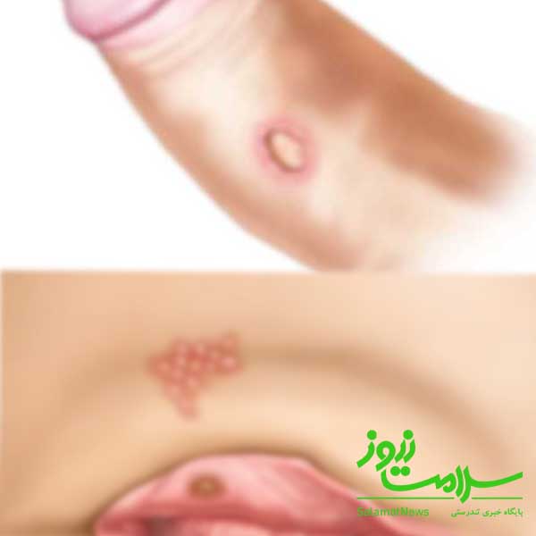 انواع سیفلیس ،نحوه انتقال و روش درمان