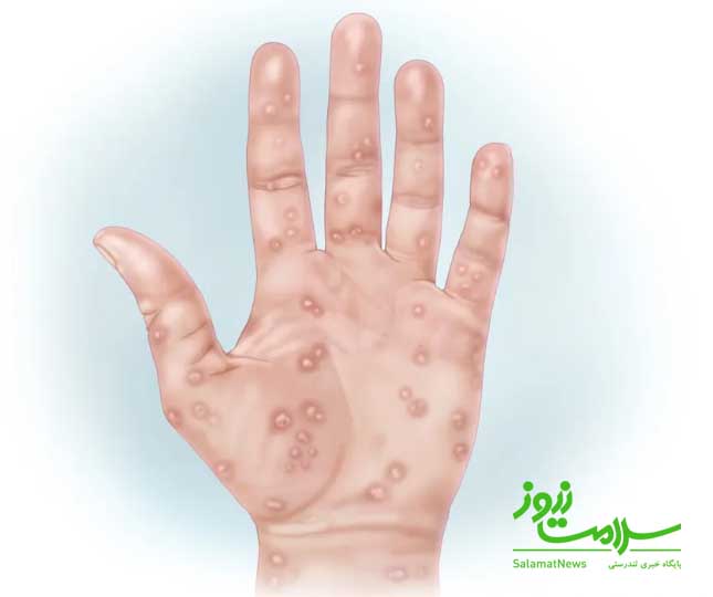 انواع سیفلیس ،نحوه انتقال و روش درمان