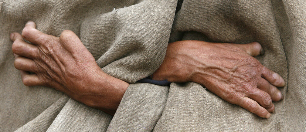 عکس/ناگفتههایی از زندگی با جذام عکس/ناگفتههایی از زندگی با جذام