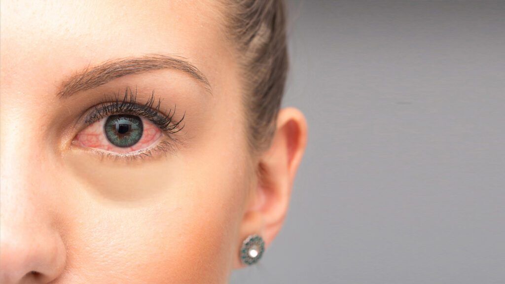 همه نکاتی که از قرمزی چشم باید بدانید همه نکاتی که از قرمزی چشم باید بدانید