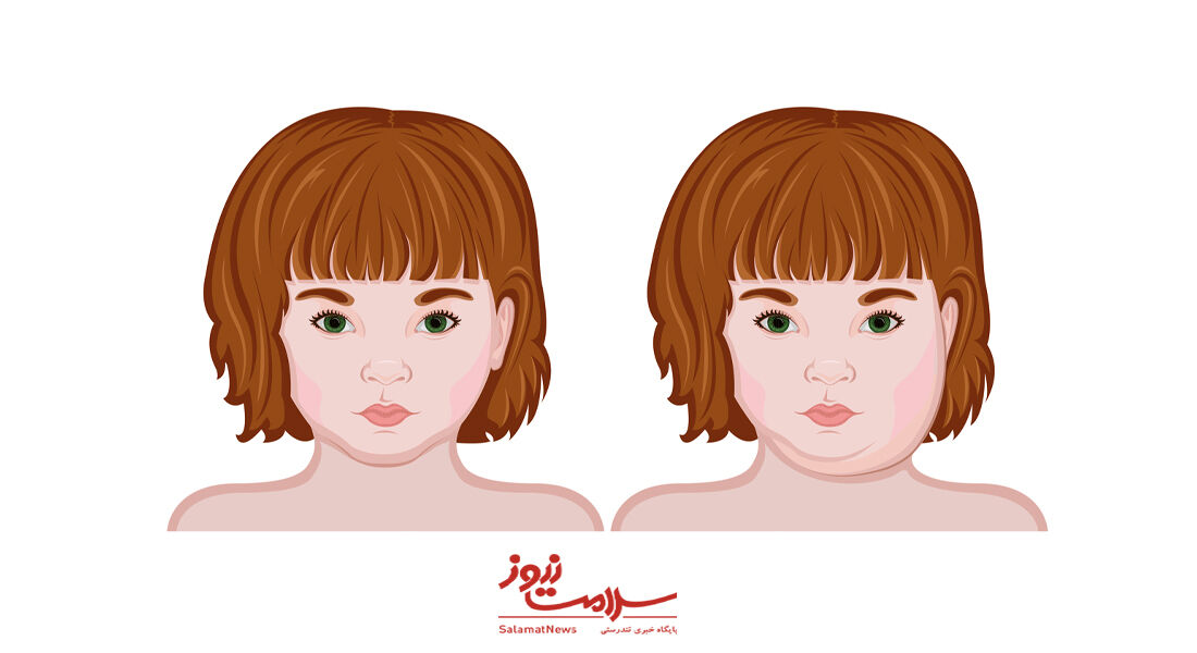 علائم و عوارض ابتلا به اوریون  علائم و عوارض ابتلا به اوریون