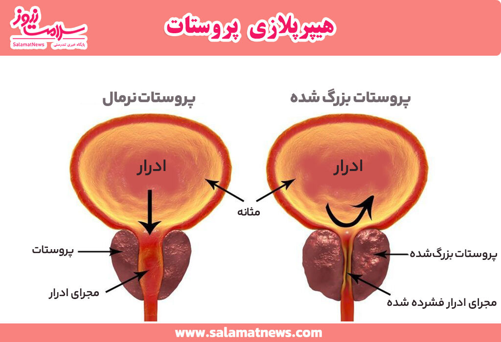 بزرگی یا هایپرپلازی پروستات چیست و چگونه درمان می شود؟