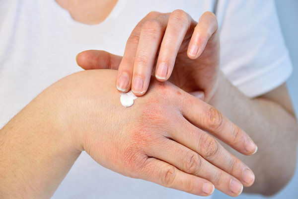 رعایت بهداشت مهم‌ترین عامل درمان حساسیت‌های پوستی