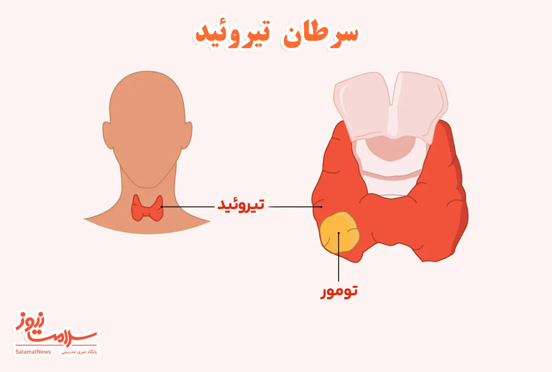 علائم، تشخیص و درمان سرطان تیروئید  علائم، تشخیص و درمان سرطان تیروئید