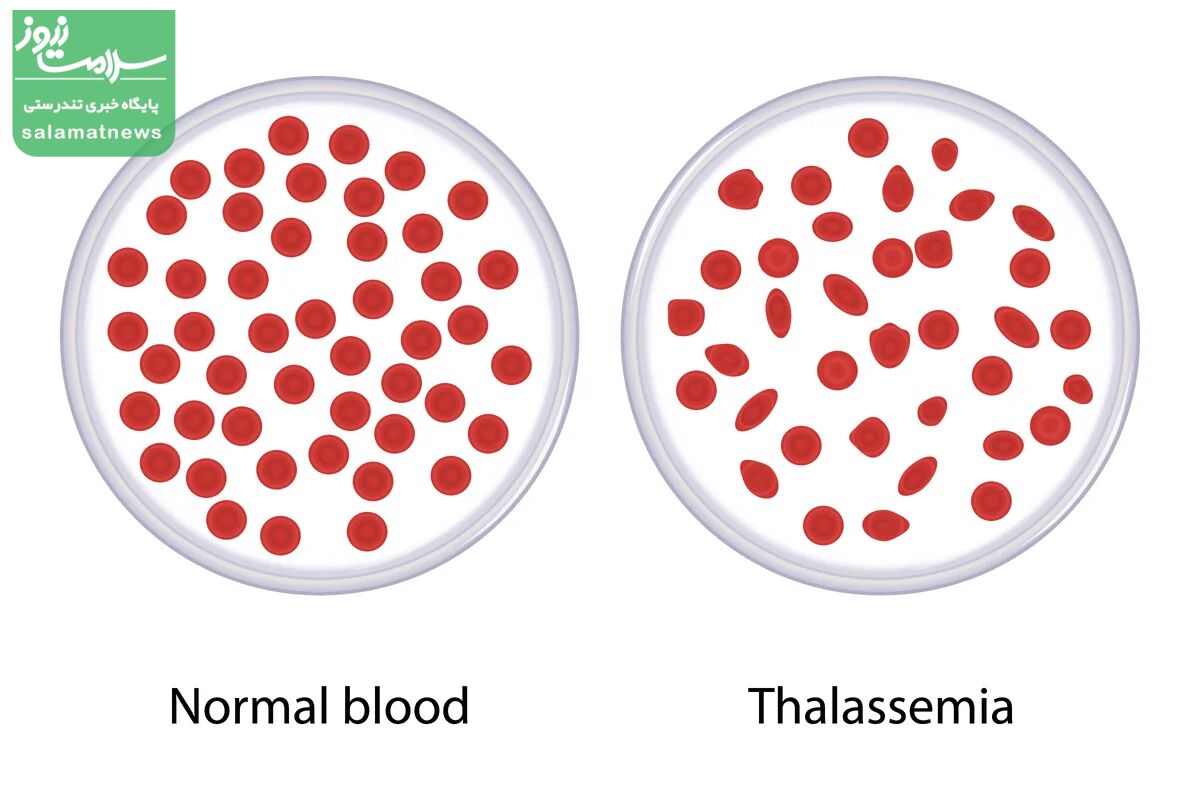 علت ابتلا به تالاسمی چیست؟چگونه درمان میشود؟