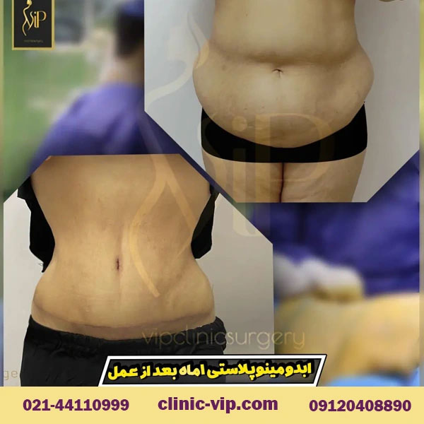 آیا عمل لیپوماتیک برگشت پذیر است؟