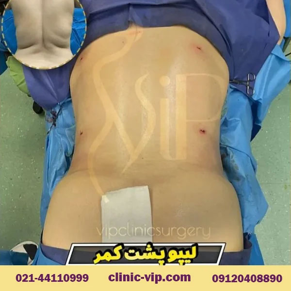 آیا عمل لیپوماتیک برگشت پذیر است؟