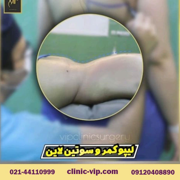 آیا عمل لیپوماتیک برگشت پذیر است؟