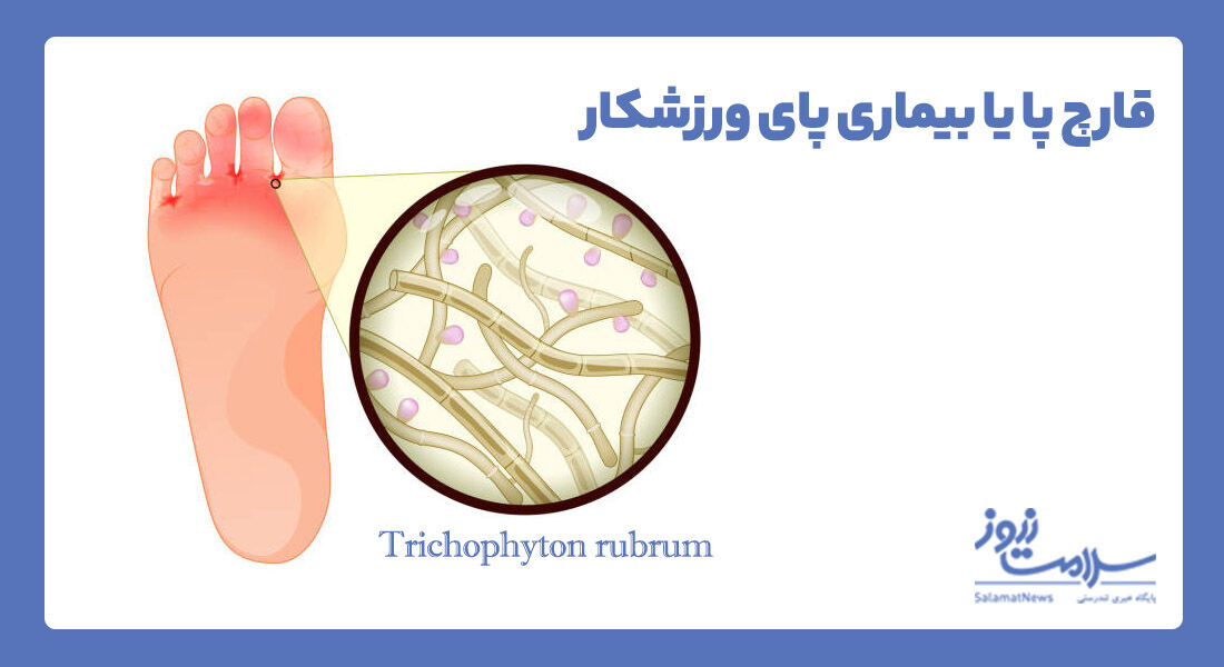 قارچ پا یا بیماری پای ورزشکار چیست؟ قارچ پا یا بیماری پای ورزشکار چیست؟