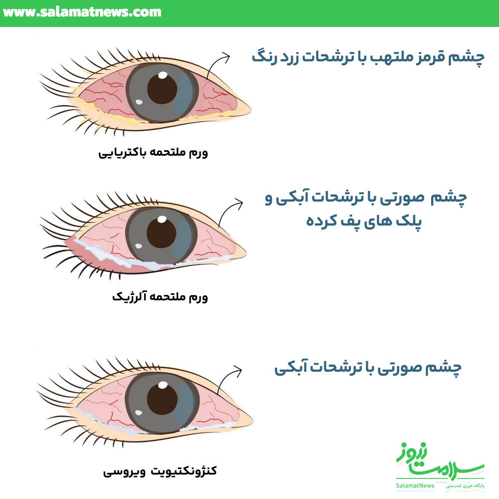 ورم ملتحمه