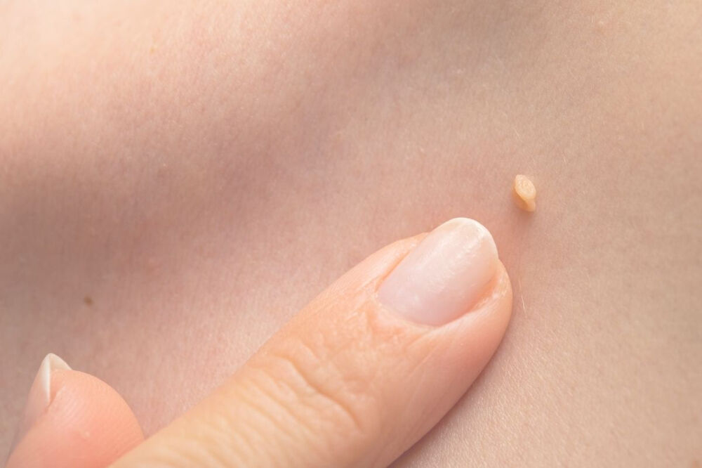 همهچیز درباره ویروس اچپیوی و موجی که در ایران راهانداخت همهچیز درباره ویروس اچپیوی و موجی که در ایران راهانداخت