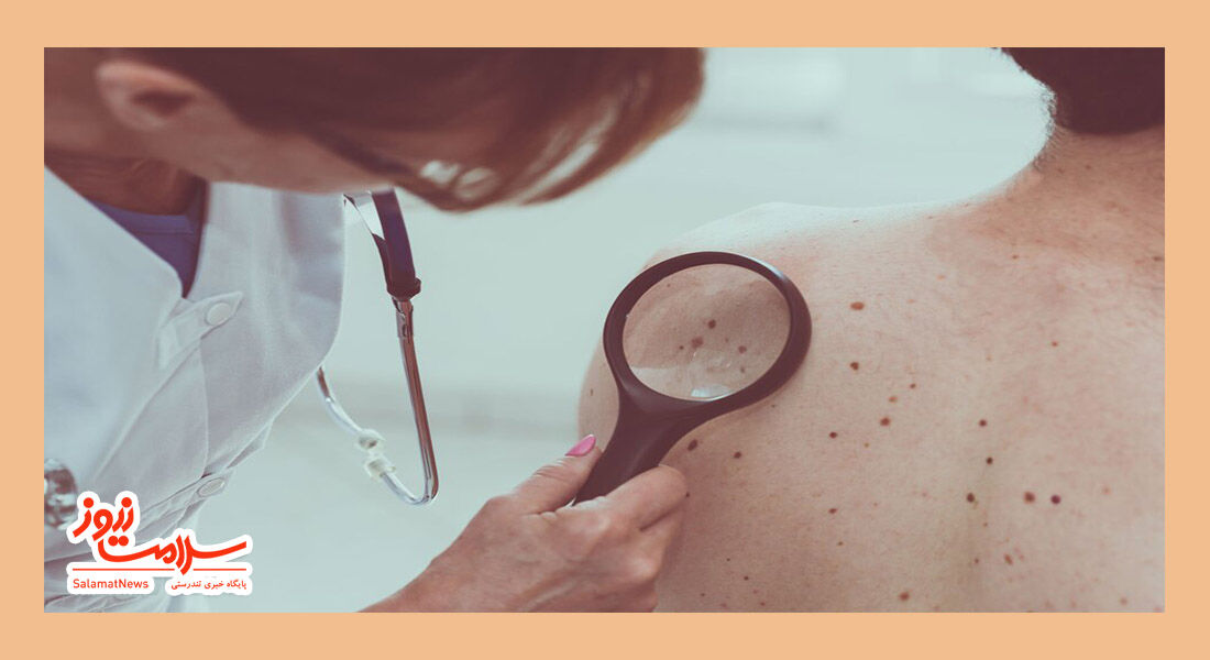 هر چیزی که باید درباره سرطان پوست "ملانوم" بدانید هر چیزی که باید درباره سرطان پوست "ملانوم" بدانید